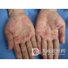 梅毒护理须知