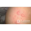 急性梅毒通哪些症状表现
