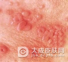 骨与关节梅毒的相关治疗