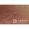 传染性软疣与尖锐湿疣有什么关系