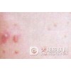 预防传染性软疣的简单介绍