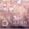 毛发苔藓的诱发因素