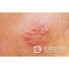 带状疱疹要怎么分辨出