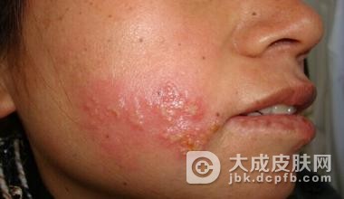 淋病要如何进行自我保健呢