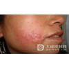淋病要如何进行自我保健呢