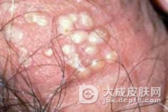 生活中我们应该怎么样去预防淋病