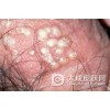生活中我们应该怎么样去预防淋病