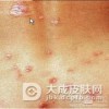 淋病在潜伏期的时候能传染么