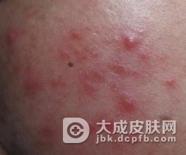 脸上经常长粉刺该怎么办