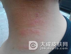 三招助你远离冬季过敏性皮炎