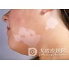 局限性白癜风症状是什么