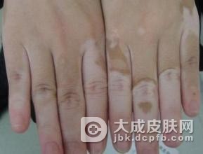 青少年患上了白癜风该怎么办
