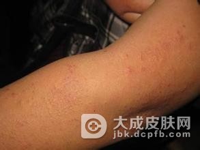 过敏性皮炎有两种