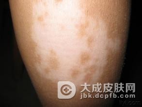 白癜风容易长在什么地方