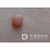 患了神经纤维瘤该怎么办
