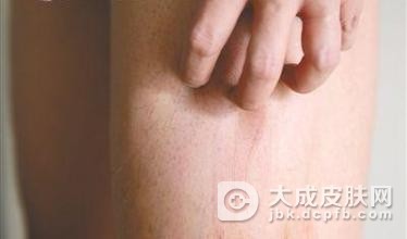 得了皮肤瘙痒如何护理比较好
