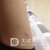 哪些原因诱发热性荨麻疹