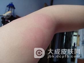 孩子得了荨麻疹会传染吗