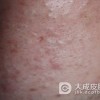 甲沟炎疾病具体分为哪些类型