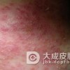 过敏性皮炎吃什么对病情好