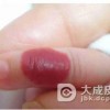 如何检查确诊宝宝淋巴血管瘤