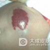 混合型血管瘤是什么病