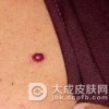 混合型血管瘤的危害有哪些