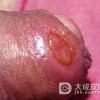 判断梅毒是否治好了？