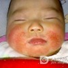 新生儿生儿得了湿疹应该注意什么
