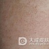 毛囊角化症有哪些症状