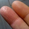 湿疹的症状是什么