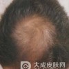 常见脱发的类型有哪些