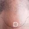避孕药诱发女性脱发的原因