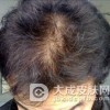 脱发治疗的注意事项有哪些
