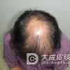 女性脱发治疗要注意哪些