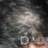 导致女性脱发的重要因素