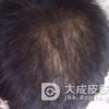 压力造成男女性都会出现脱发