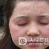 扁平疣都有哪些传染途径呢