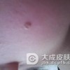 扁平疣是到底是什么病