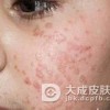 扁平疣和老年斑的区别