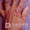 扁平疣的日常护理有哪些措施
