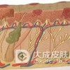 扁平疣日常护理的方法有哪些