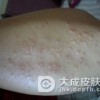 扁平疣患者如何保护皮肤