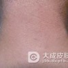 遗传性对称性色素异常症是什么回事
