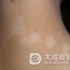 白癜风会传染吗？