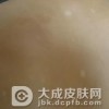 白癜风会遗传吗