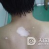 白癜风如何诊断