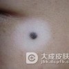 生姜可以治白癜风吗