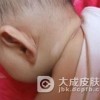 白癜风患者适合吃什么