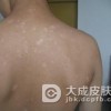白癜风的饮食要注意什么？